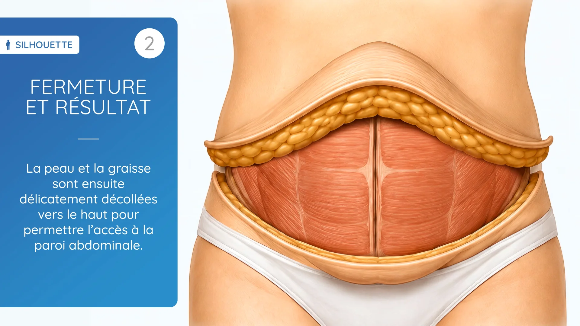 Création d'un vidéo AI sur l'abdominoplastie pour le Dr Picovski